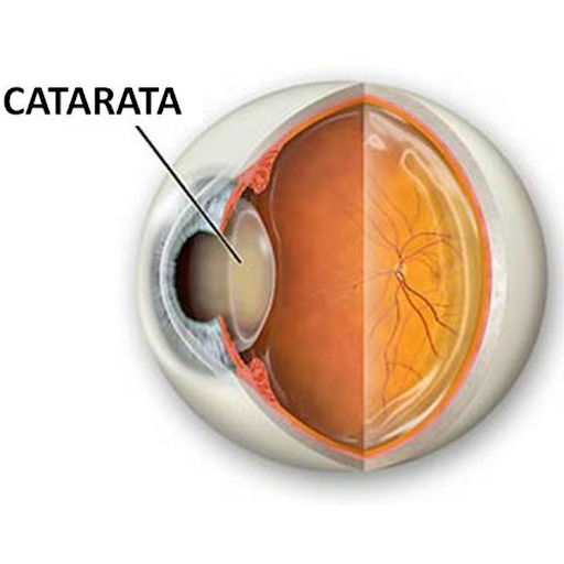 O que é catarata?