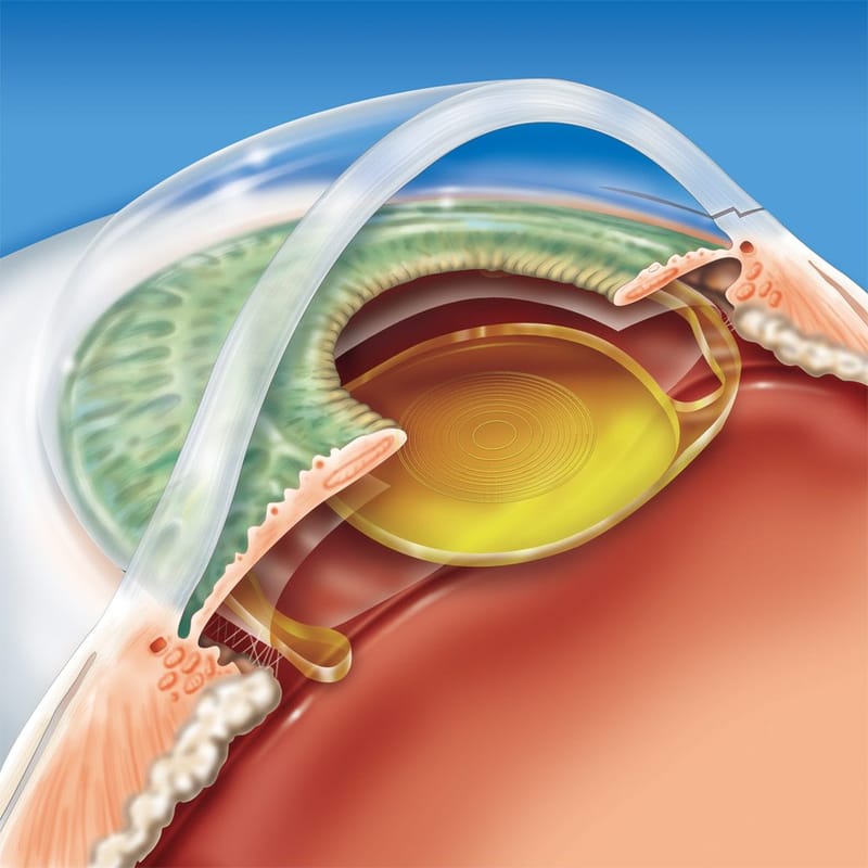 Escolhendo a melhor lente intraocular