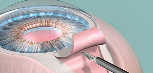 E em quem tem glaucoma?