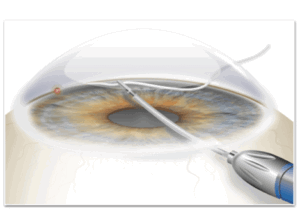 MIGS - GATT (Gonioscopy-Assisted Transluminal Trabeculotomy)