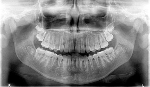 اشعة بانوراما الاسنان بالكويت Panorama X-ray