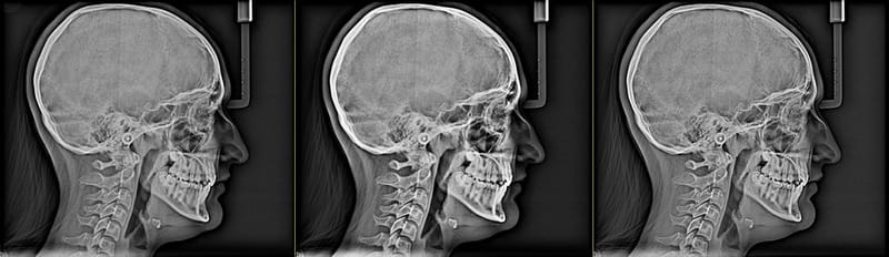 اشعة تقويم الأسنان بالكويت Lateral Cephalometry X-Ray