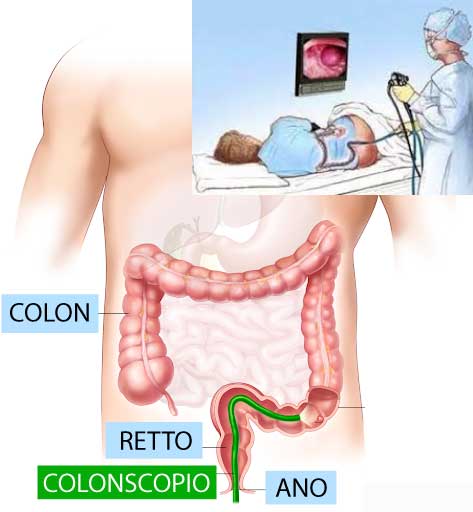 Colonscopia