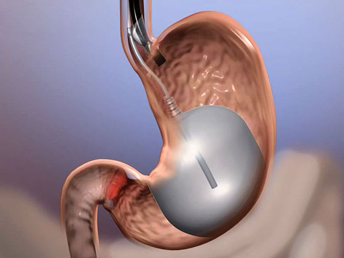 Palloncino intragastrico per il trattamento dell'obesità