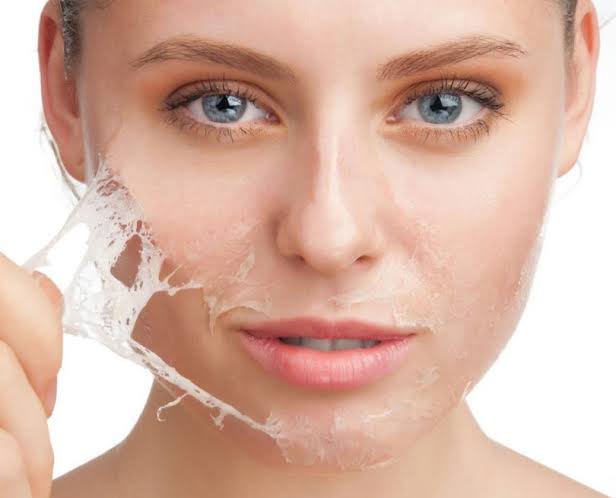 Peeling Químico