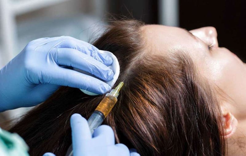 Stop the fall and treat baldness.. the secret lies in the injection of plasma