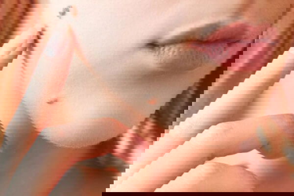 Removing moles and birthmarks using a laser