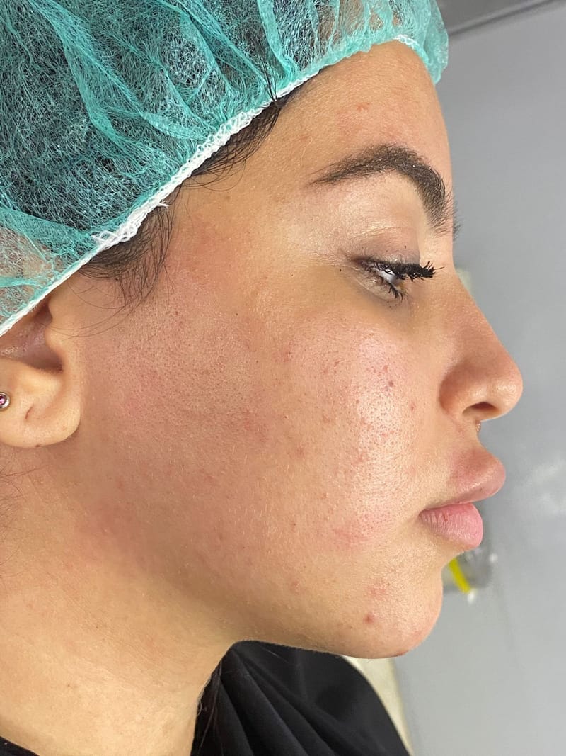 Spectra laser for bleaching lanugo hair in the face