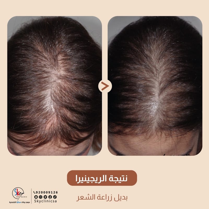 Regenera technology to intensify hair and treat hair loss