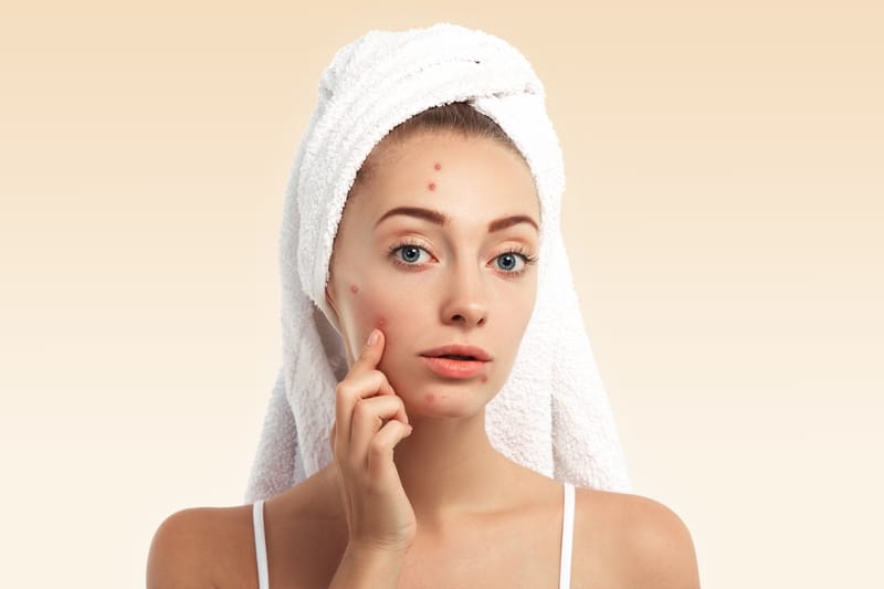 Say goodbye to acne scars with the Infini technique