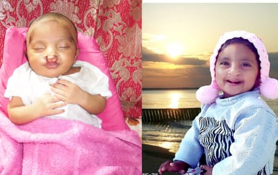 Cleft Palate Surgery image