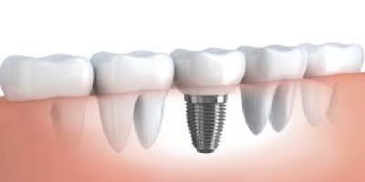 Tips to replace a missing tooth!