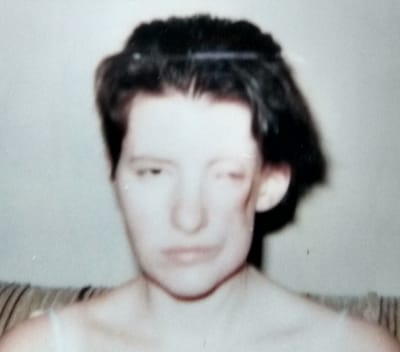 After silicone implant was removed