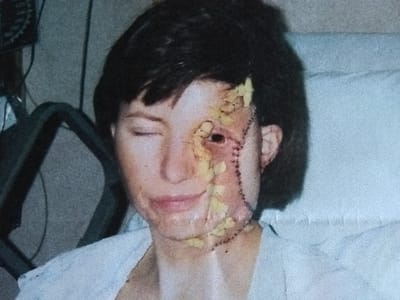 My last reconstructive surgery