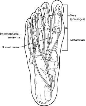 Steroid injection for Morton's Neuroma