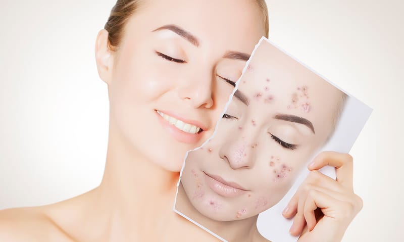 علاج آثارحب الشباب وأحدثّ التِقنيات المستخدمة