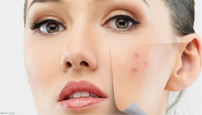 الطُـرق والأساليب..هـكذا يتم إزالة أثار حَب الشَباب