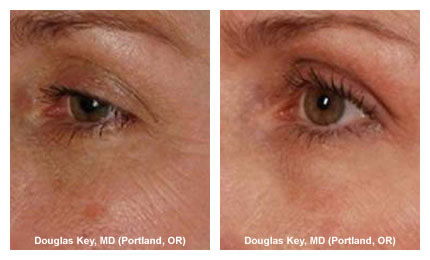 فراكشِنال ليزرمن نوع ديكا يَنضم لعائلة الـموج فِرع الصَفا