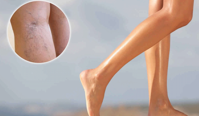 الدواليّ عندَ النـساء مُشكلة شائعة ومزعجة، حلُها لديّنا