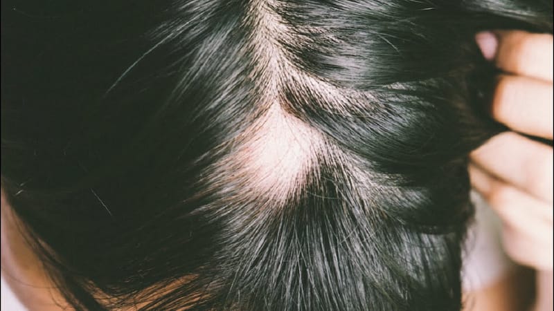 الثعلبة في الشعر، الأَسباب والأَعراض وطرق العِلاج في عياداتنا