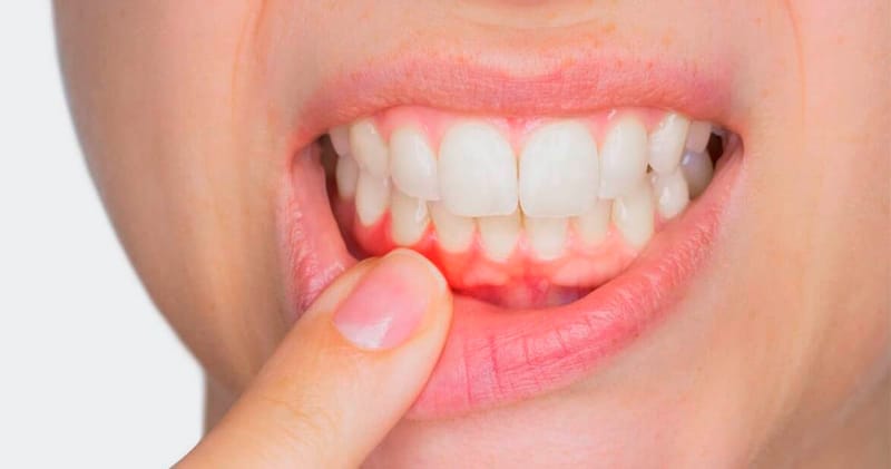 معلومات مهمة حولَ التهابات اللثة