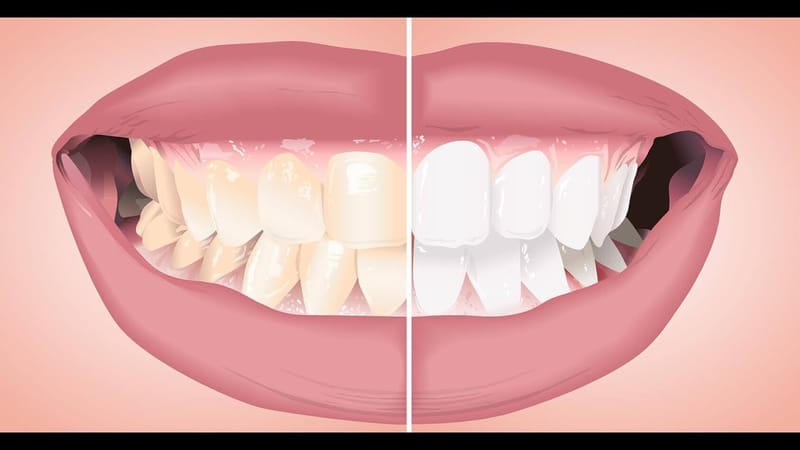 تبييض الأسنان بتقنية الزووم