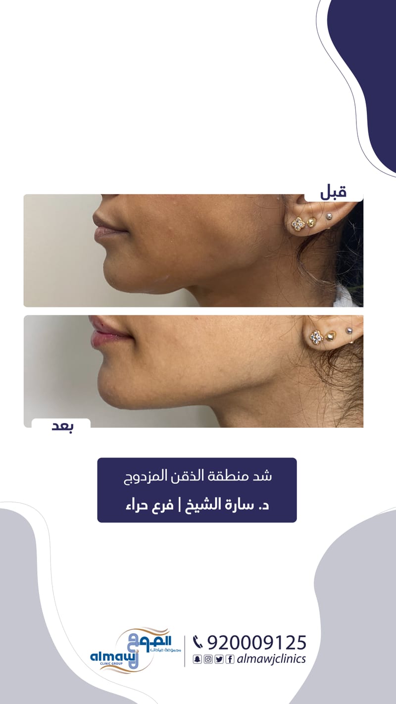 التخلص من الذقن المزدوج بتقنيات متعددة