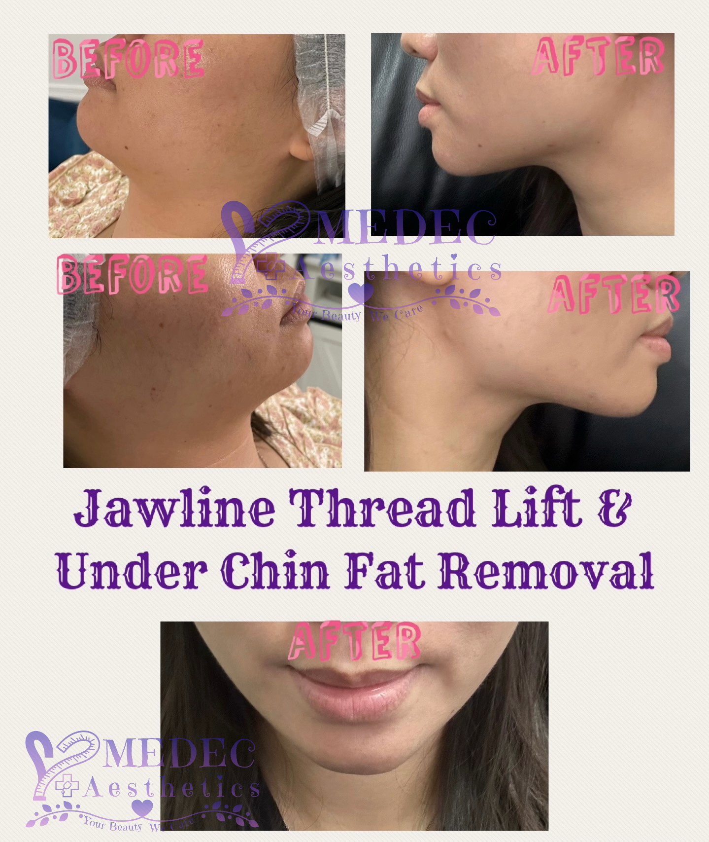 Kybella PC/DC Double Chin Fat Removal Under Chin Fat Reduction Submental Fat Remove Jawline Thread Lift