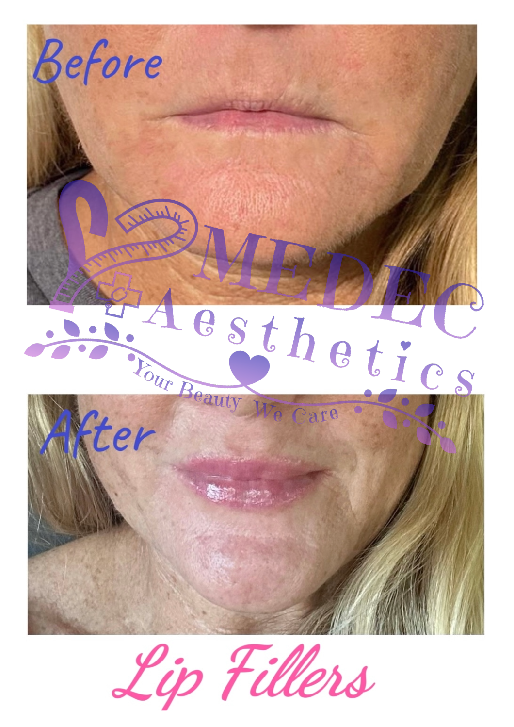 Juvederm Revanesse Versa Lips Filler Lips Enhancement Medec Medical Aesthetics