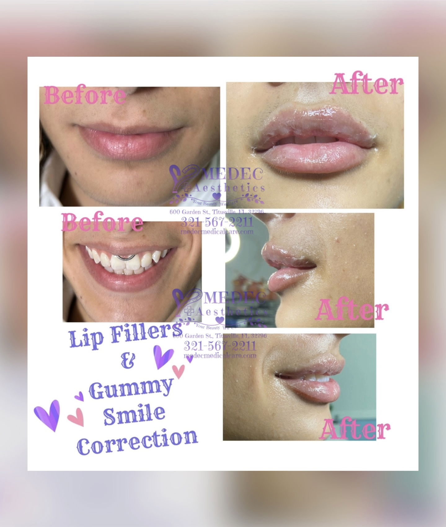 Juverderm Lips Filler Revanesse Versa Lip Enhancement Gummy Smile Correction Medec Medical Aesthetics