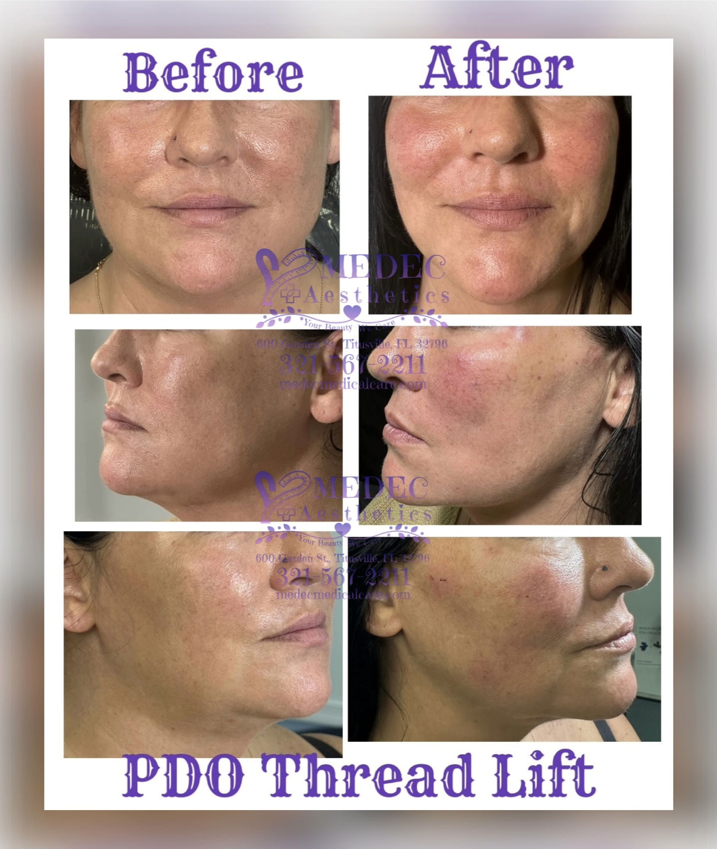 Illari PDO Threads Lift Jawline Face Lift Facial Lift Medec Medical Aesthetics