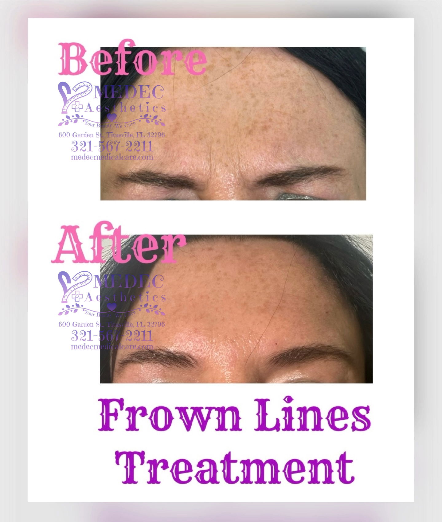 Frown Lines Glabellar Crow's Feet 11 Lines Treatment Botox Xeomin Medec Medical Aesthetics