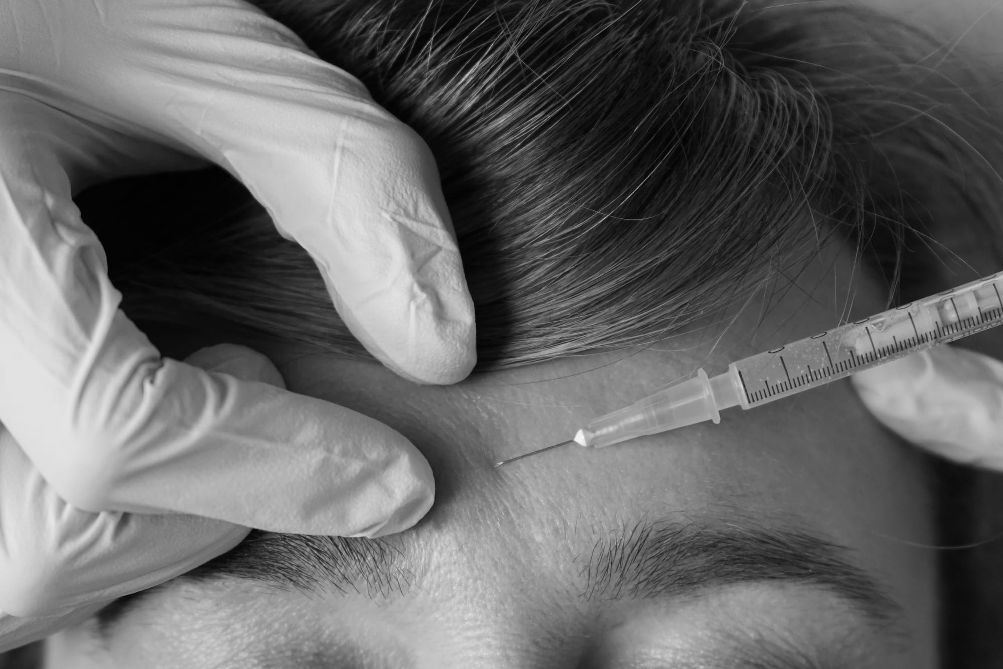 HARMONIZAÇÃO FACIAL (BOTOX, ÁCIDO HIALURÓNICO, FIOS, BIOESTIMULADORES)