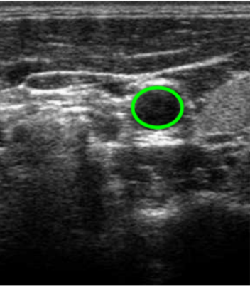 Automatic Segmentation of lumen intima layer in transverse mode ultrasound images
