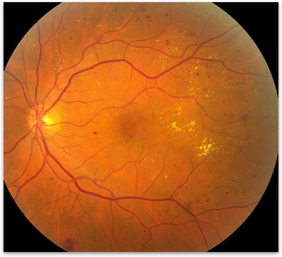 Diabetic Retinopathy