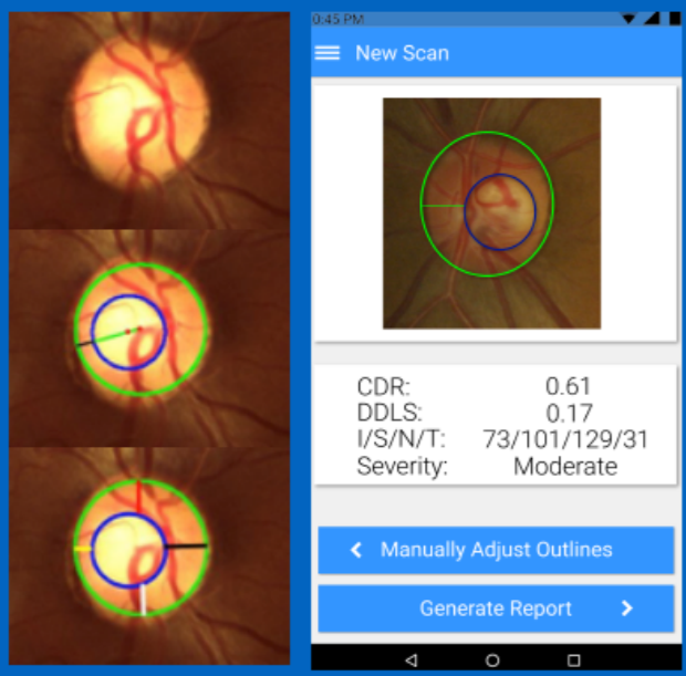 Glaucoma Severity Grading