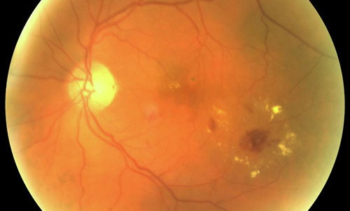 Microaneurysm Detection