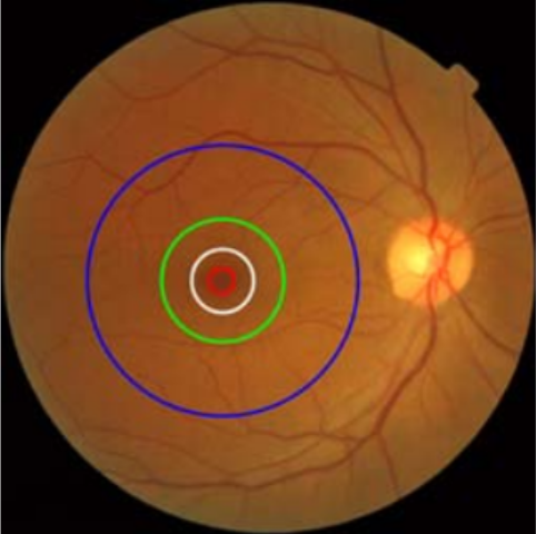 Macular Degeneration