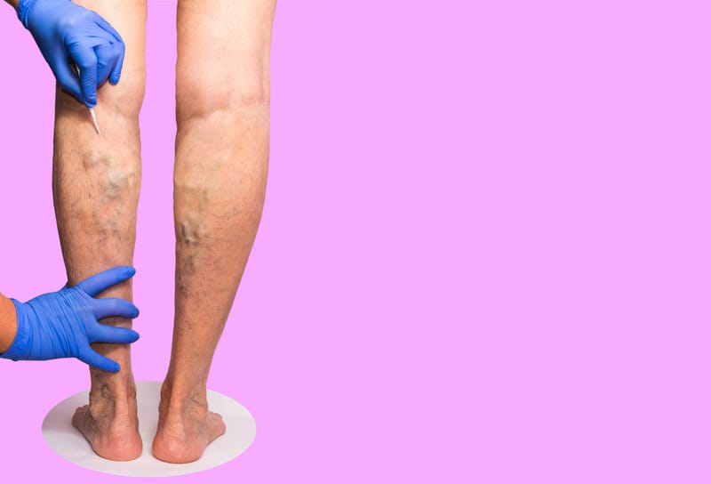 Are Varicose Vein Removal Treatments Covered by Insurance in New York?