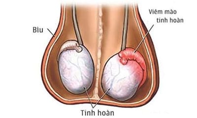 Một số giải pháp chữa viêm tinh hoàn như nào