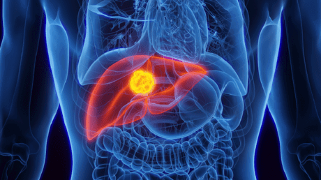 ابتكار مهم" يمنع انتشار السرطان و"ينهي" عذاب العلاج الكيميائي