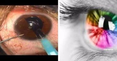 قرار بمنع تغيير لون "عيون العراقيين" وحصر العمليات بـ"الترميم".. وثيقة