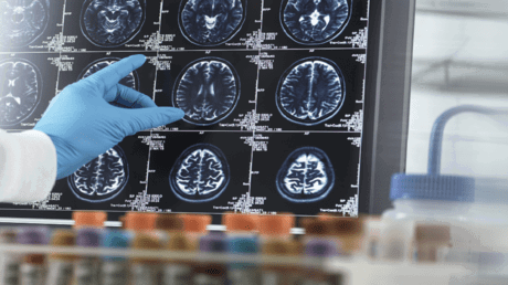 الأول من نوعه.. اختبار مبتكر يتنبأ بالخرف قبل 9 سنوات من التشخيص.