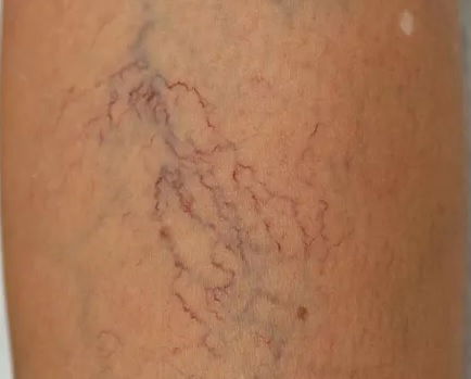 Spider Veins Treatment