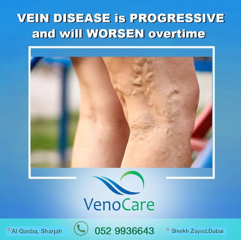 Varicose Veins Treatments