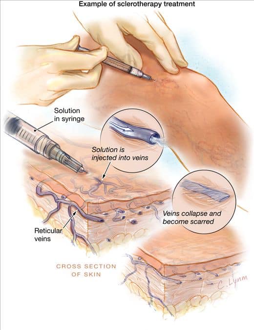 Varicose Veins