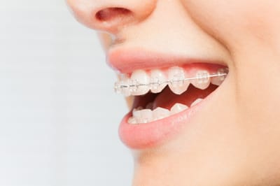 The Benefits of Braces