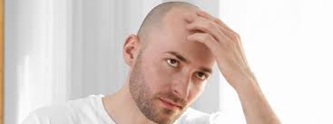 Advancement in Hair Transplantation