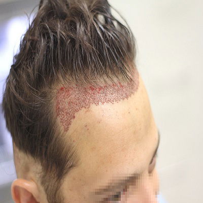 Hair Transplantation Is The Best Hair Treatment