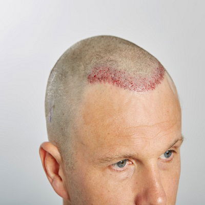 Effective Female Hair Transplant Methods